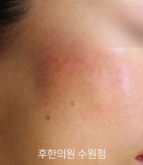 치료 후