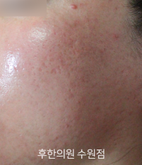 치료 전