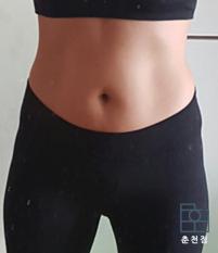 치료 후