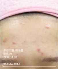 치료 전