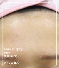 치료 후