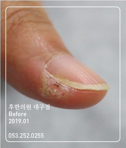 치료 전