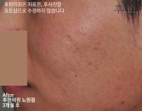 치료 후