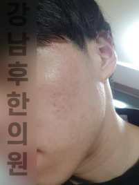 치료 후