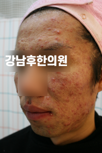 치료 전