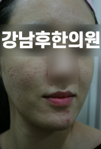 치료 전