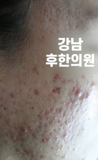 치료 전