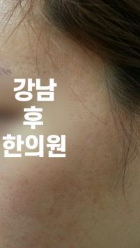 치료 후