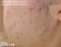 치료 전