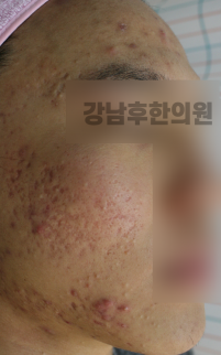 치료 전