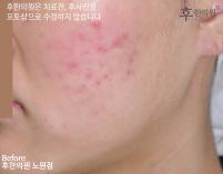 치료 전