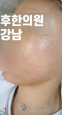 치료 후