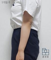 치료 후