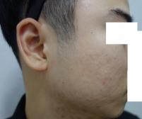 치료 후