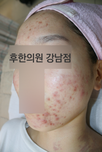 치료 전