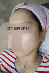 치료 후