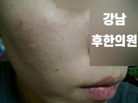 치료 전