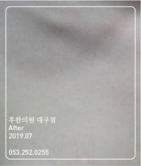 치료 후