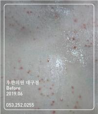 치료 전