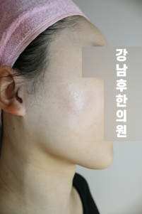 치료 후