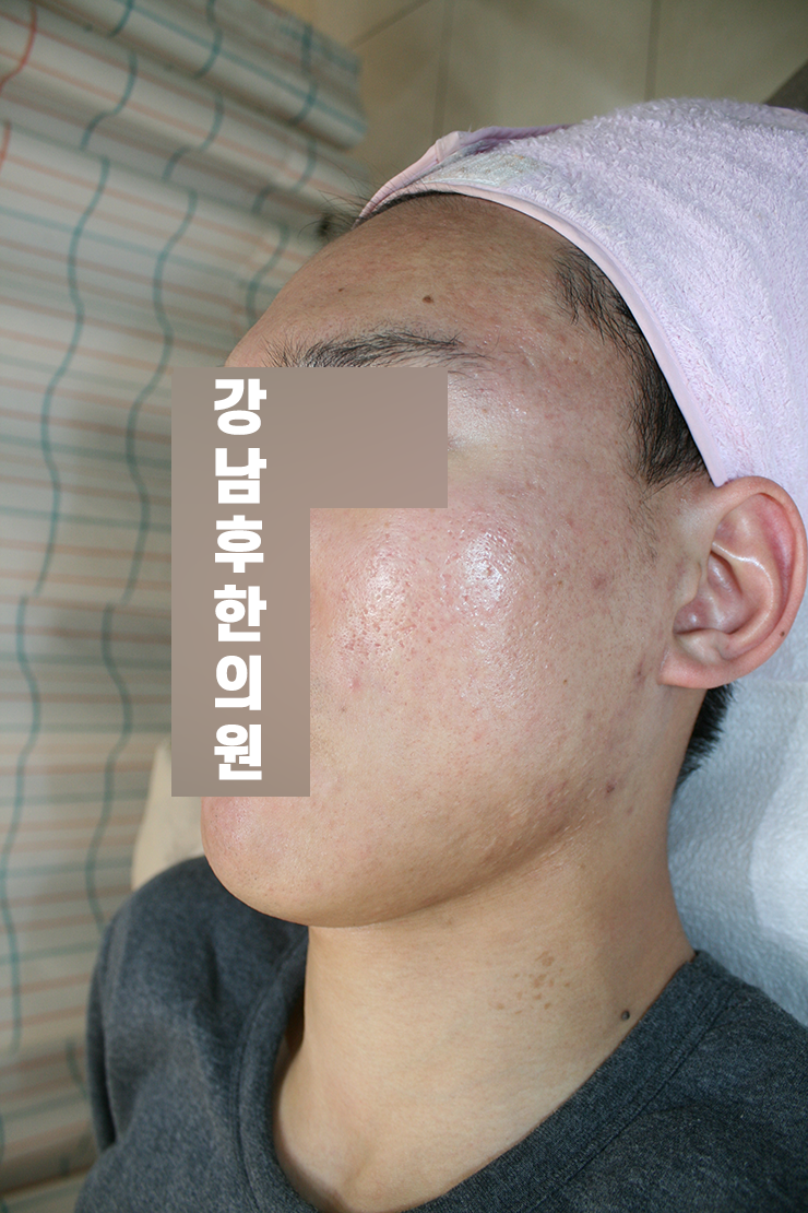 치료 후