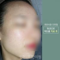 치료 후