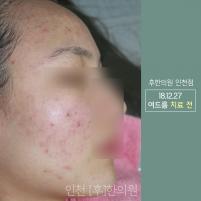 치료 전