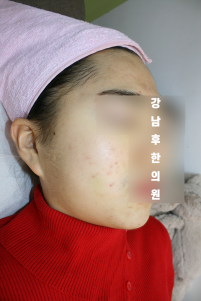 치료 후