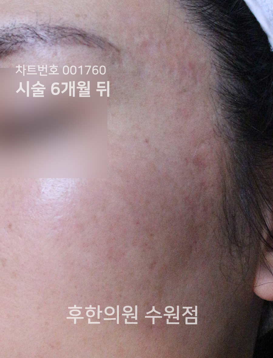 치료 후
