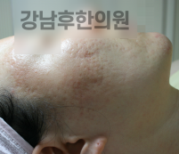 치료 전