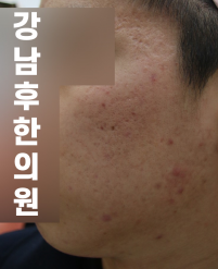 치료 전