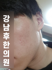 치료 후