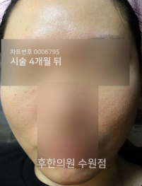 치료 후