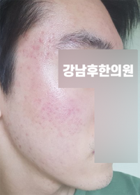 치료 후