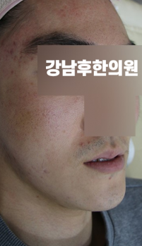 치료 전