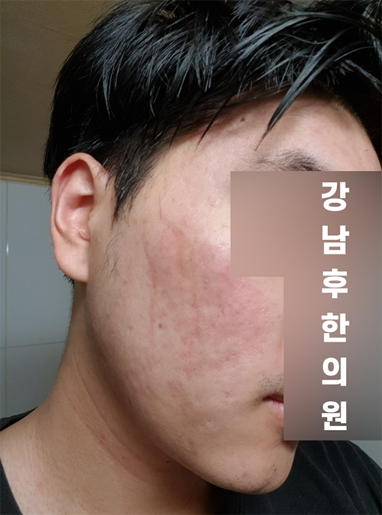 치료 후