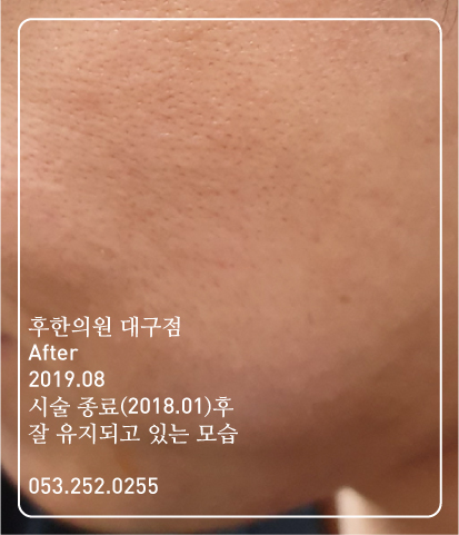 치료 후
