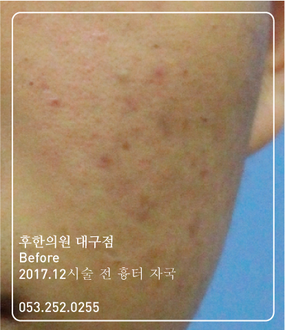 치료 전