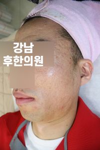 치료 후