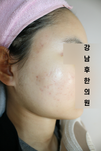 치료 후