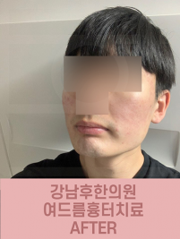 치료 후