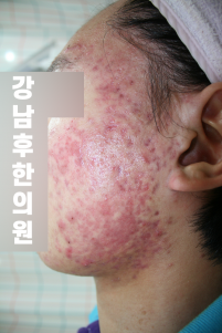 치료 전