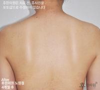 치료 후