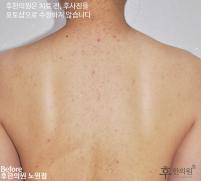치료 전