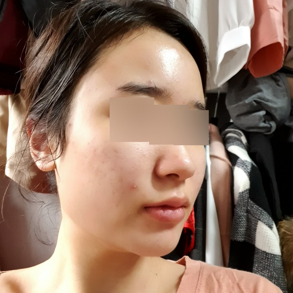 치료 후