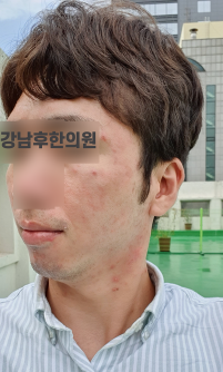 치료 후