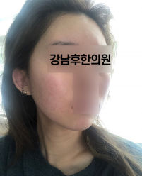 치료 후