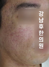 치료 전