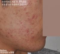 치료 전