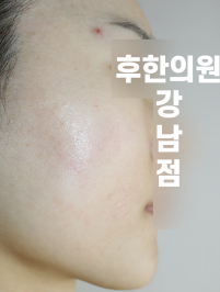 치료 후